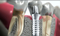 Имплантология